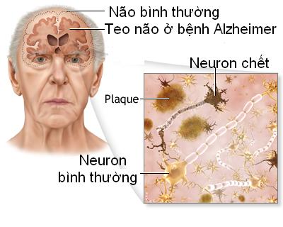 Sa sút trí tuệ - Hình ảnh minh họa